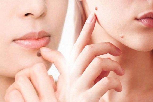 Tẩy nốt ruồi để lại sẹo lõm phải làm sao? | Vinmec