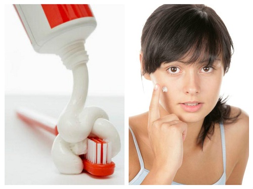 Cách trị mụn bằng kem đánh răng chỉ sau 1 đêm thực hư ra sao