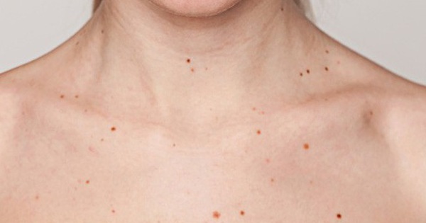 Dấu hiệu xuất hiện nếp nhăn vùng cổ ở các mẹ tuổi trung niên｜Skinliftcollagen | MamiBuy