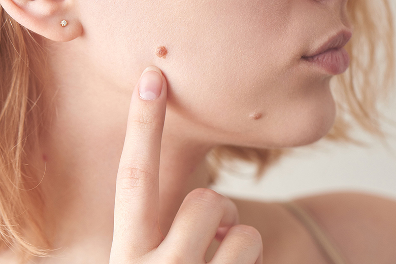Dấu hiệu nhận biết nốt ruồi bị ác tính hóa và cách phòng ngừa