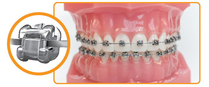 Niềng răng mắc cài kim loại tự buộc giá bao nhiêu tiền ?