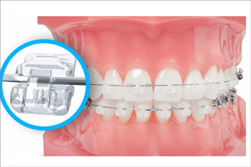 Phương pháp niềng răng mắc cài sứ tự đóng, tự buộc