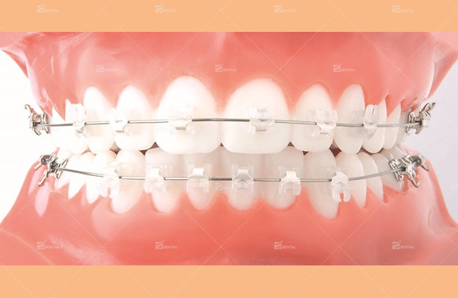 Niềng Răng Có Tác Dụng Gì? Các Phương Pháp Niềng Răng Phổ Biến