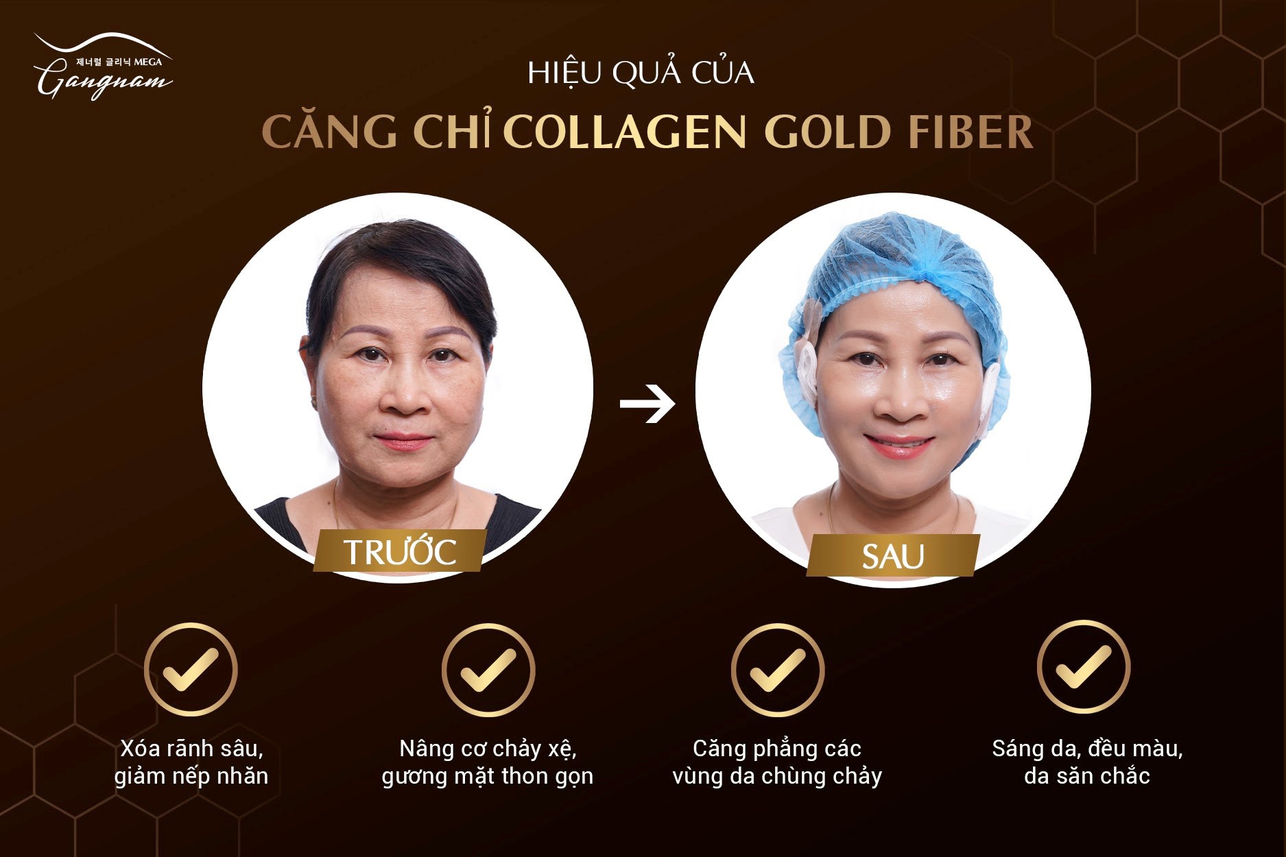 Lợi ích căng chỉ collagen tại Mega Gangnam