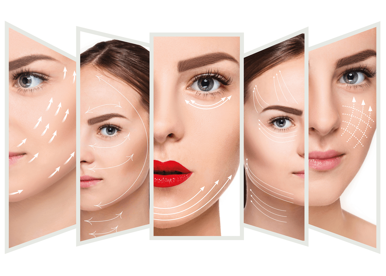 Quy trình căng da mặt bằng chỉ Collagen
