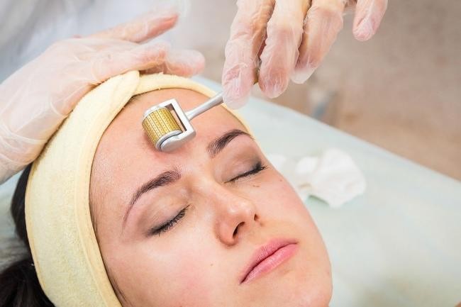 Những điều bạn cần lưu ý về phương pháp lăn kim - YouMed